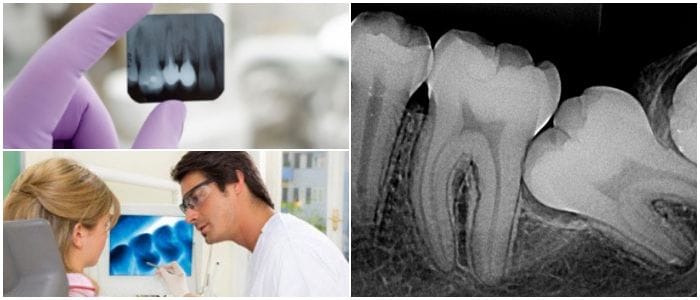 como es la radiografía periapical en adultos