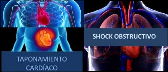 como es el manejo del shock obstructivo