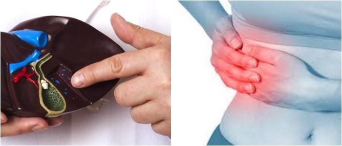 cuales son los sintomas de vesicula biliar con piedras