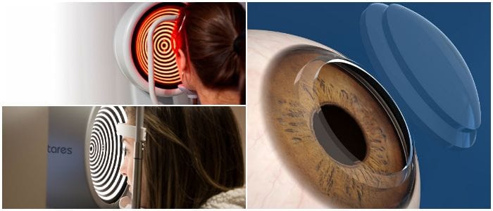 que es la topografía corneal basada en la elevación