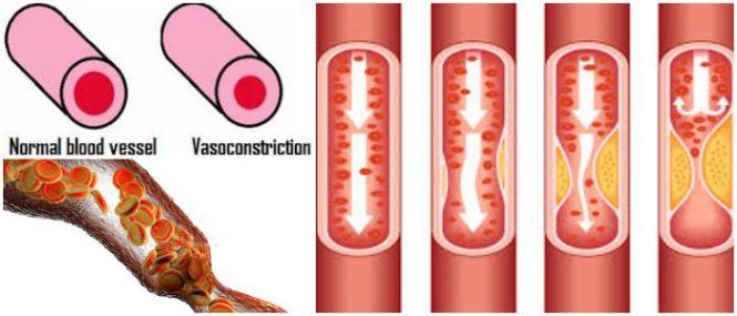 cual es el tratamiento de la vasoconstricción en bebes