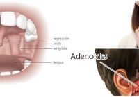 como se hace la adenoidectomia adultos