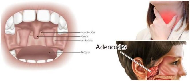 como se hace la adenoidectomia adultos