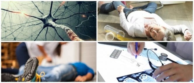 cuales son los síntomas del ataque epiléptico