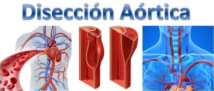 que significa la disección aortica grupo b