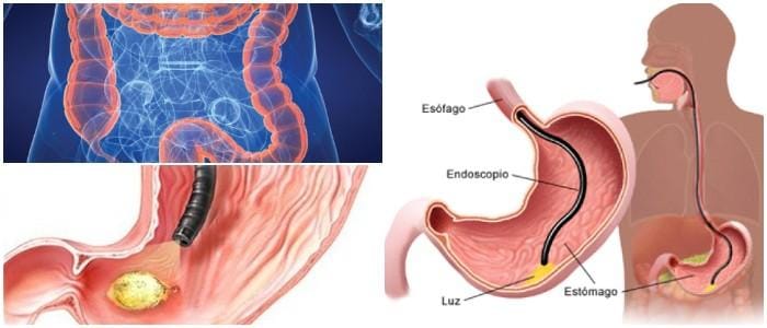 que es la endoscopia digestiva baja