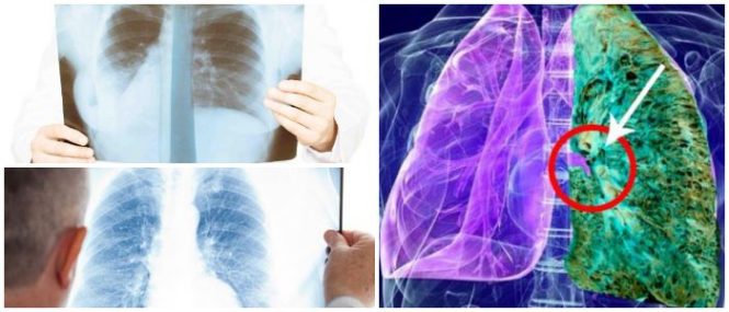 que es la fibrosis pulmonar idiopatica