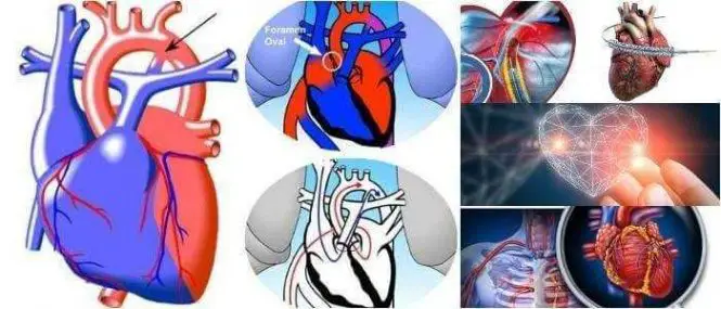 que es un foramen oval abierto