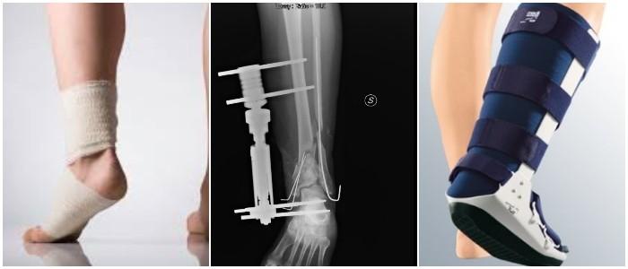 Fractura De Perone Tipos Causas Sintomas Diagnostico Tratamiento Prevencion Y Complicaciones Arriba Salud