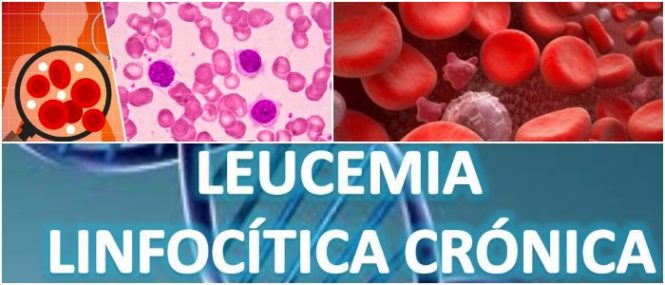 tiene cura y tratamiento la leucemia linfocítica cronica