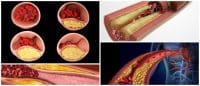 Lipemia: ¿Qué es? Enfermedades Asociadas, Causas, Síntomas, Tratamiento ...