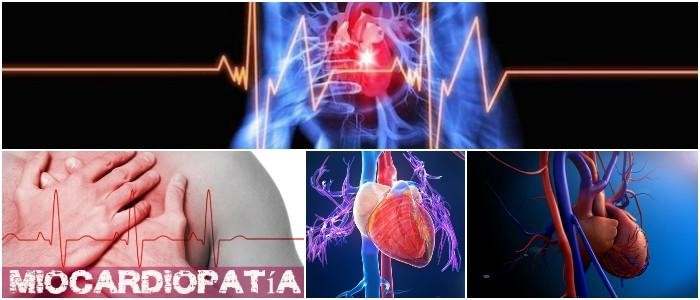 que es la miocardiopatía