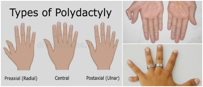 Polidactilia Definición Síntomas Causas Tipos Y Tratamiento