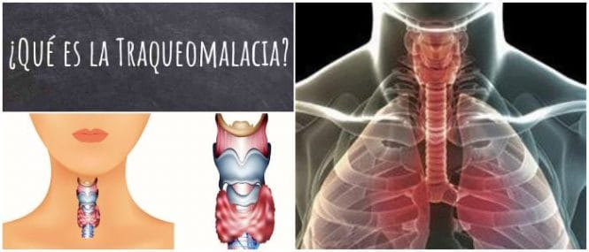 como se hace el diagnóstico de la traqueomalacia