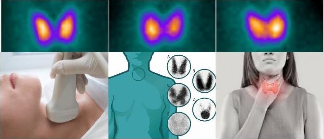 por que se produce infertilidad por yodo radiactivo