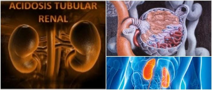 que es la acidosis tubular renal