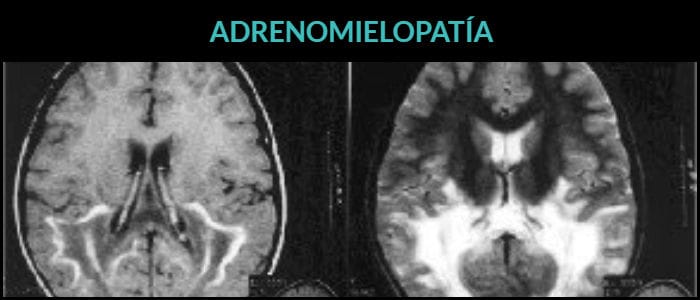 trasplante de médula para la adrenomielopatía