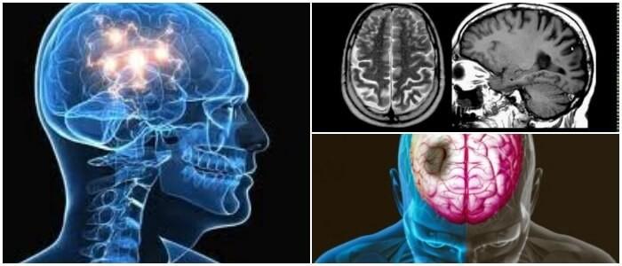 Atrofia Cerebral S Ntomas Causas Diagn Stico Tratamiento Y Panorama Arriba Salud