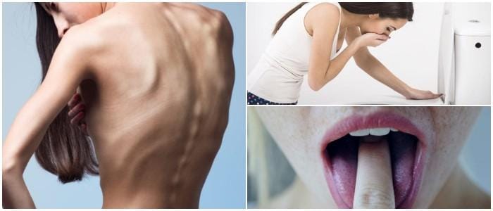 cual es la relación entre la bulimia y anorexia