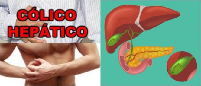 cual es el tratamiento del colico hepatico