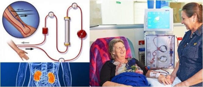 definición de diálisis renal