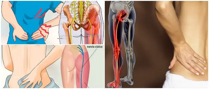 cual es el tratamiento de dolor ciático