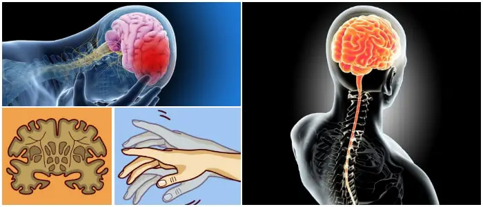 Enfermedades Del Sistema Nervioso Tipos Síntomas Causas Y Tratamientos Arriba Salud 1417