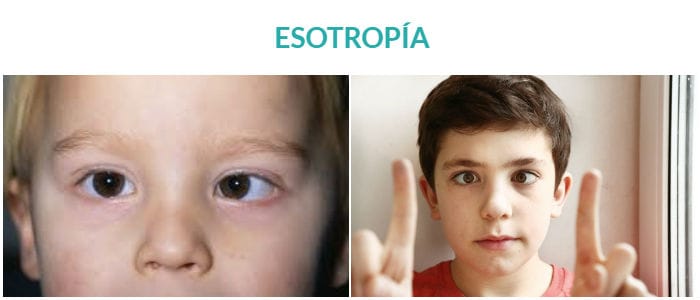 el estrabismo es un tipo de esotropía