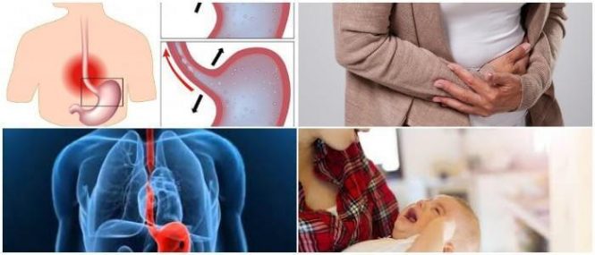 cuales son las consecuencias de la estenosis intestinal en niños