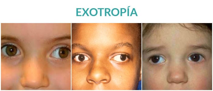 gafas para trata la exotropía