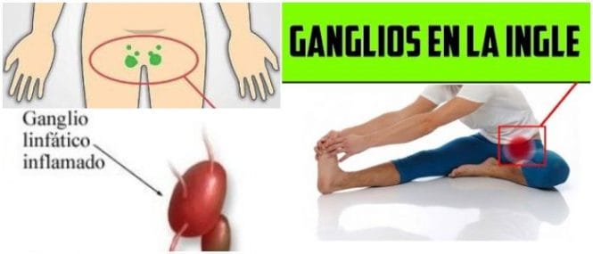 ganglios-inflamados-en-la-ingle-anatom-a-causas-de-la-inflamaci-n