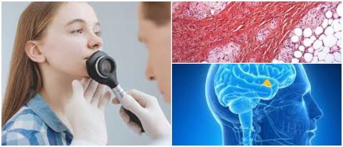relación entre un hamartoma y un tumor