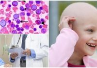 sintomas de la leucemia mieloide cronica