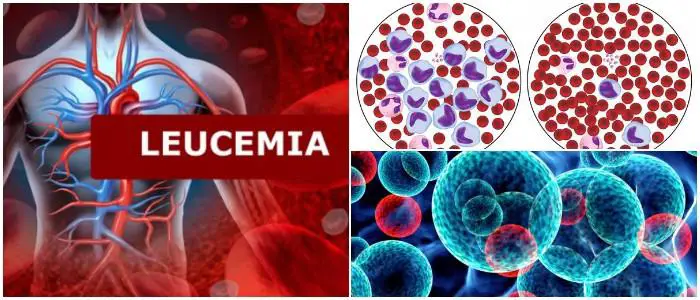 Leucemia Definición Tipos Factores De Riesgo Síntomas Diagnóstico Y Tratamiento Arriba Salud 5977