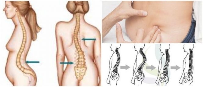 que es la lordosis cervical