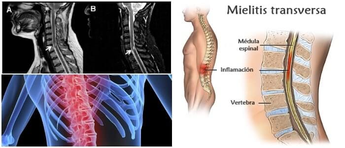 Mielitis Transversa: Causas, Síntomas, Diagnóstico, Tratamiento y  Complicaciones – Arriba Salud