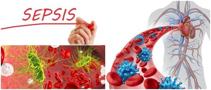 que es la sepsis neonatal