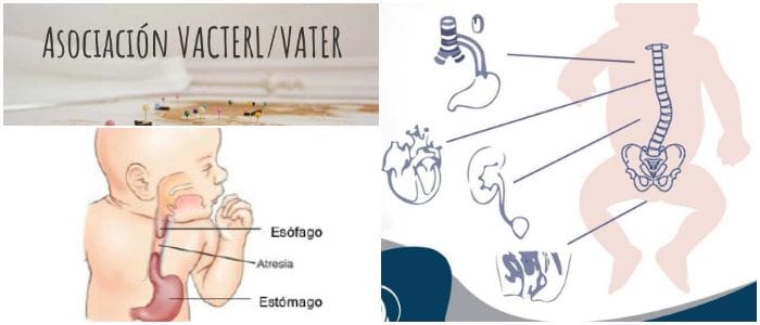 que es el sindrome de vater