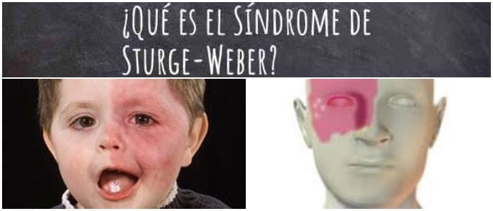 definición del síndrome de weber