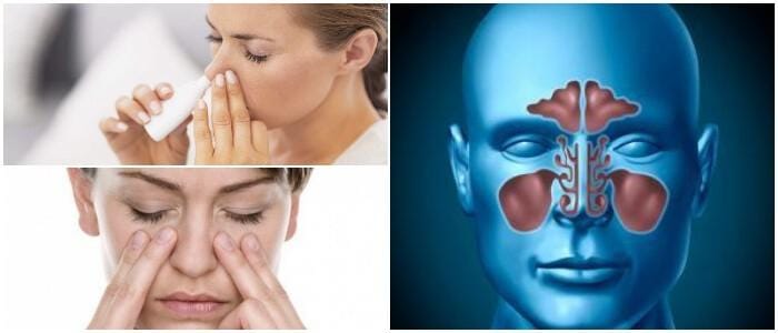 donde puedo conseguir la guía de sinusitis aguda