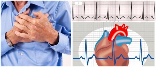 que es la taquicardia ventricular