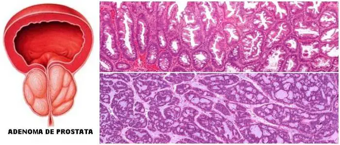 que es un adenoma suprarrenal