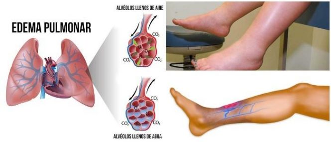 Edema Tipos Causas Factores De Riesgo Complicaciones Diagnóstico Y Tratamiento Arriba Salud