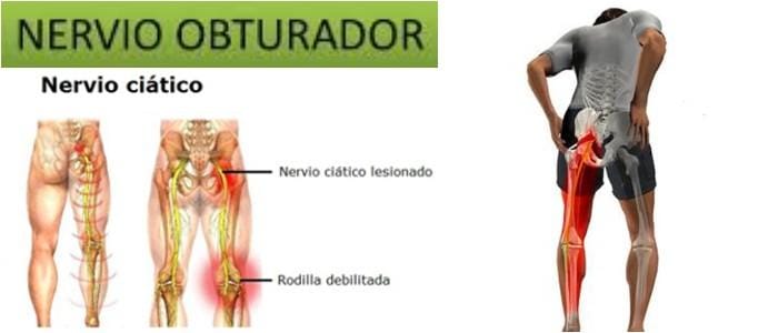 neurodinamia nervio obturador