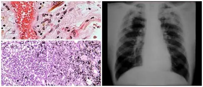 la neumoconiosis asociada con tuberculosis