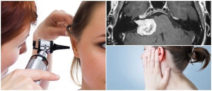que es un neurinoma acústico angulo pontocerebeloso