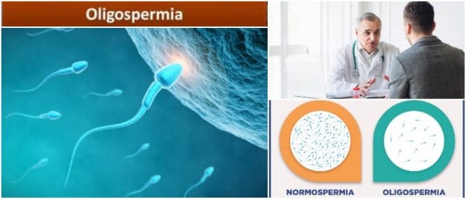 teratospermia