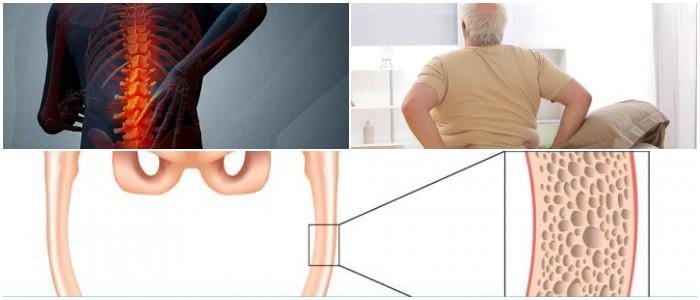 articulo de osteomalacia