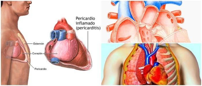 cual es la definición de pericarditis