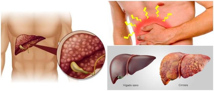 Cirrosis Definición Causas Síntomas Evolución Diagnóstico Y Tratamiento Arriba Salud 0209